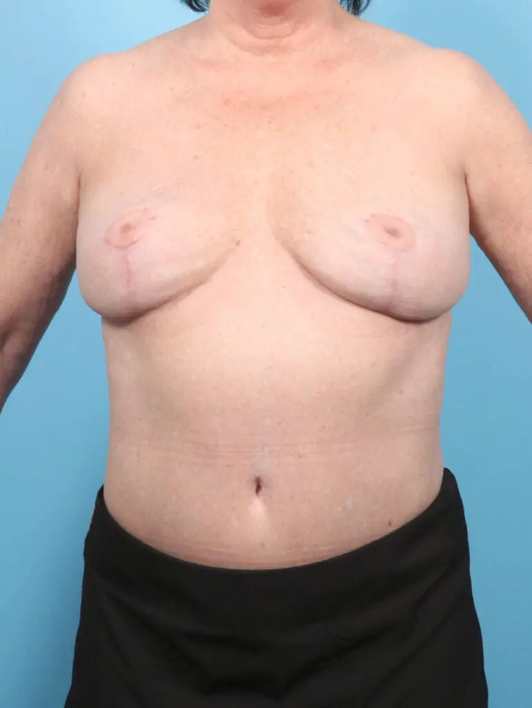 Breast Implant Removal - Case 53662 - After