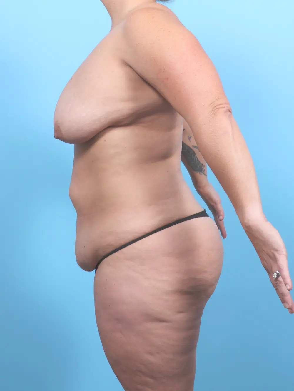Breast Lift/Reduction w/o Implants Patient Photo - Case 53670 - before view-2