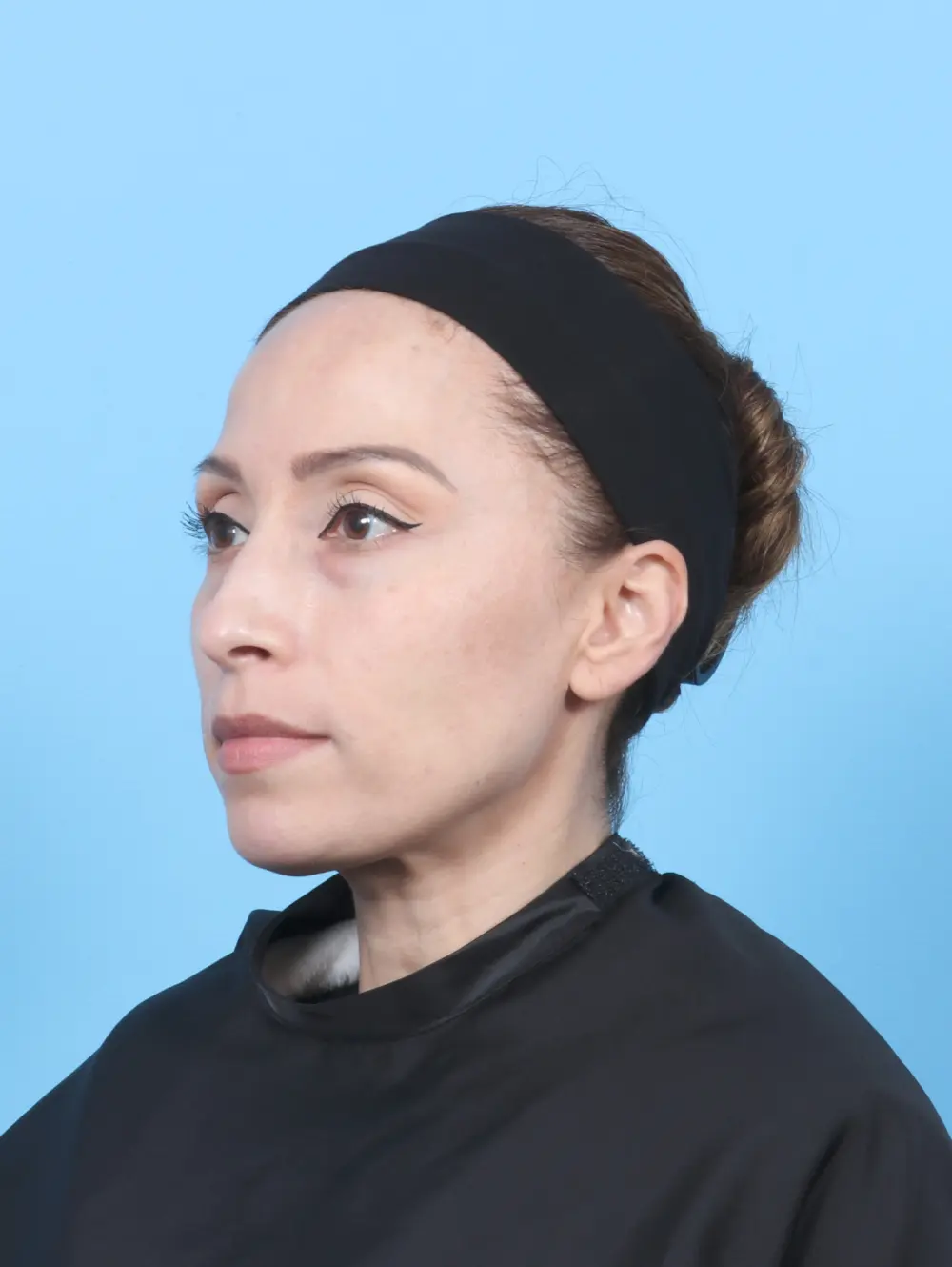 Eyelid Surgery Patient Photo - Case 53705 - before view-1