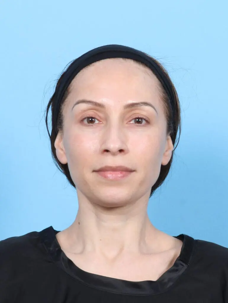 Eyelid Surgery - Case 53705 - After