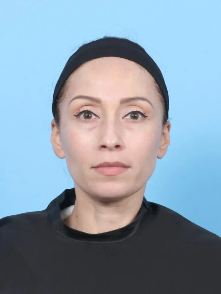 Eyelid Surgery - Case 53705 - Before