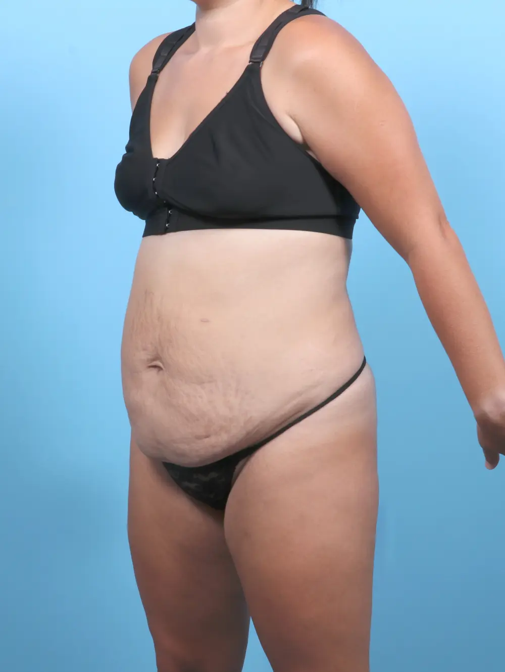 Tummy Tuck Patient Photo - Case 53784 - before view-1