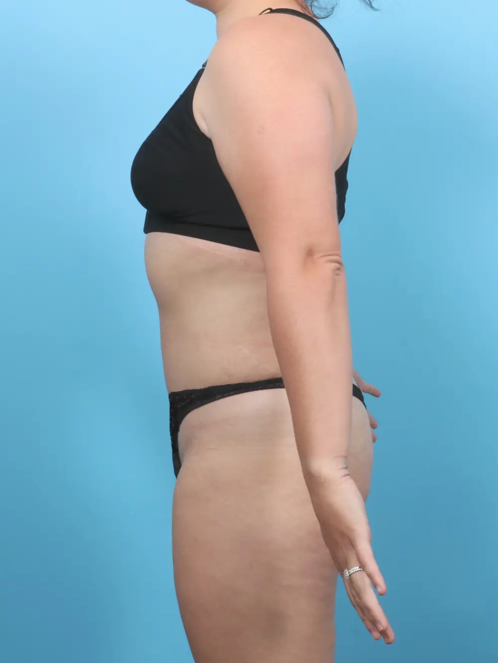 Tummy Tuck Patient Photo - Case 53784 - after view-2