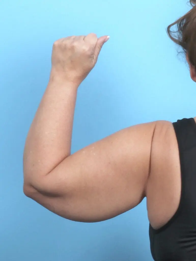 Arm Lift - Case 53811 - Before