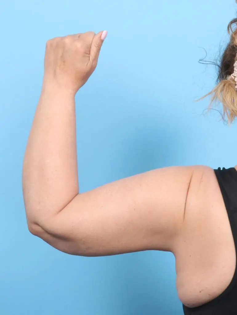 Arm Lift - Case 53811 - After