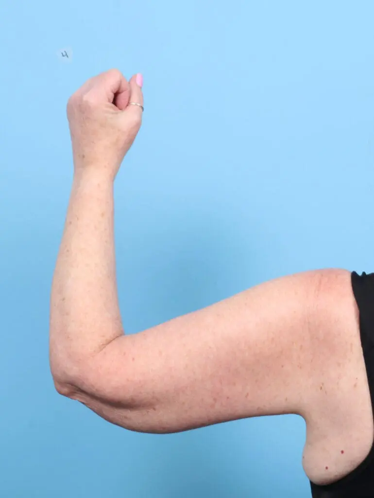 After Weight Loss - Case 53817 - After