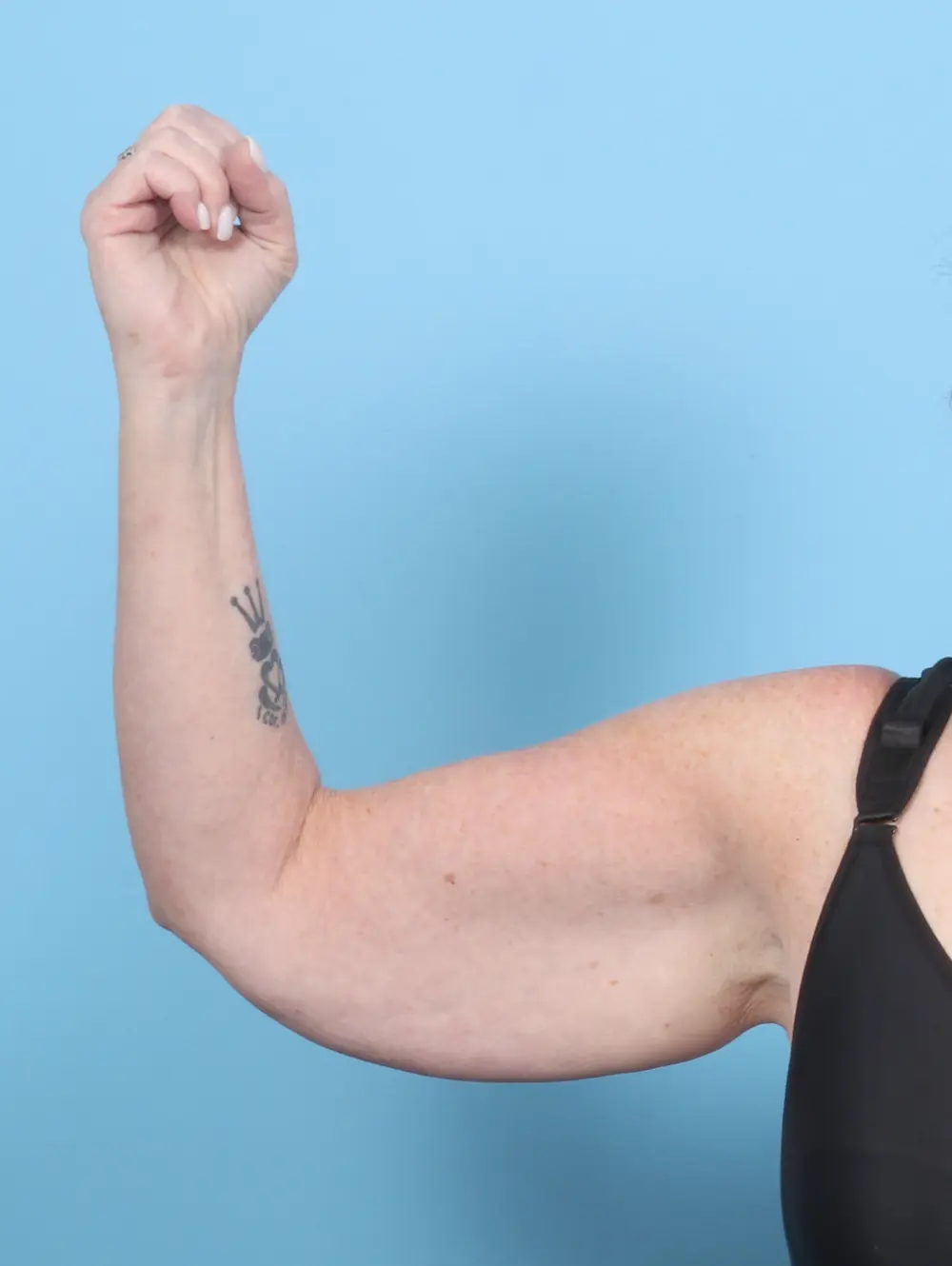 After Weight Loss Patient Photo - Case 53817 - before view-1