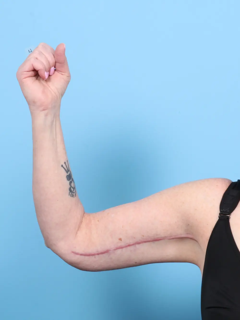 After Weight Loss Patient Photo - Case 53817 - after view-1