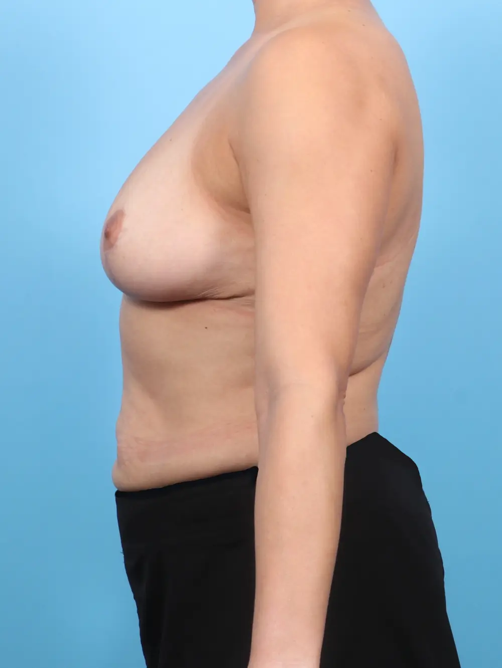Breast Lift/Reduction w/o Implants Patient Photo - Case 53834 - after view-2