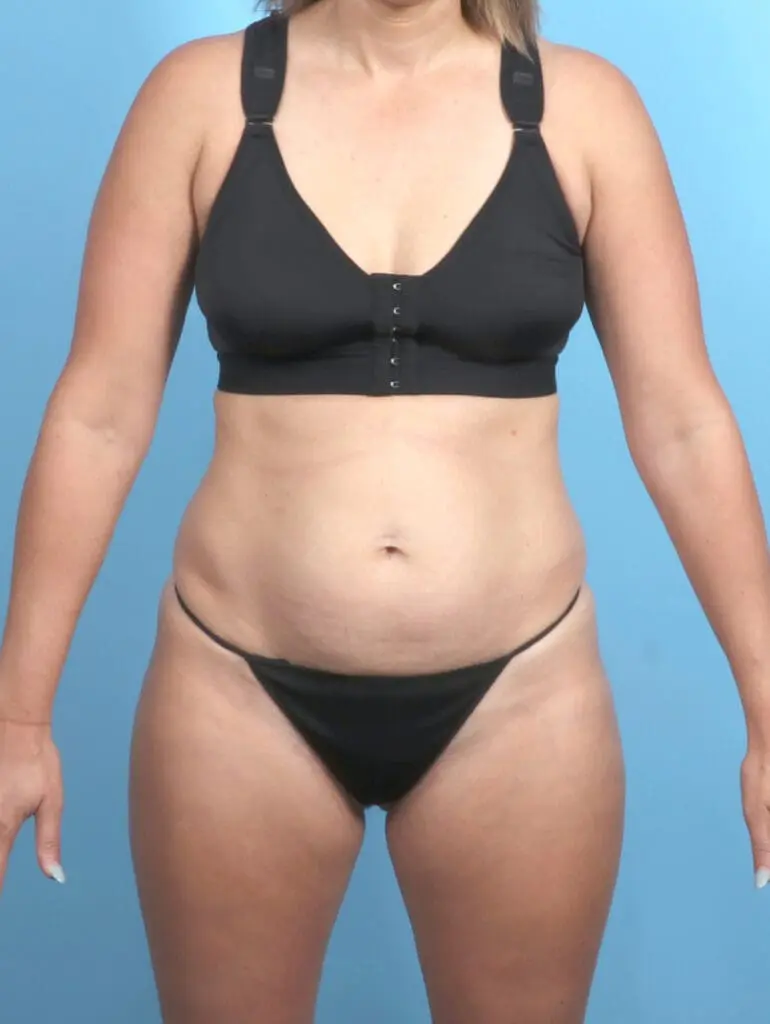 Tummy Tuck - Case 53888 - Before