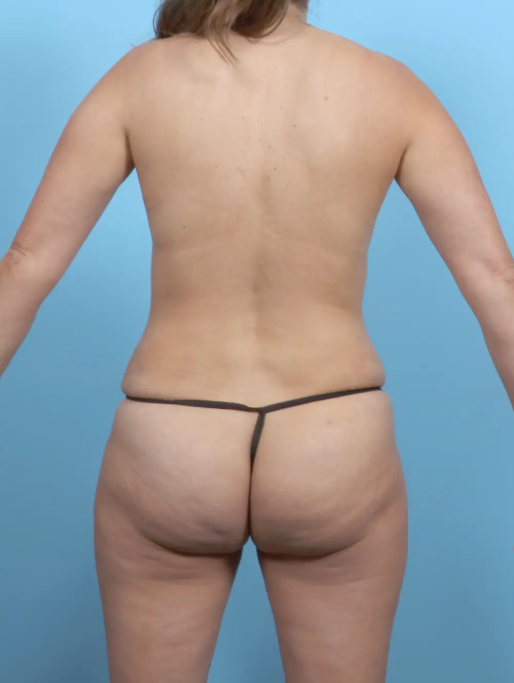 Tummy Tuck Patient Photo - Case 53888 - after view-3
