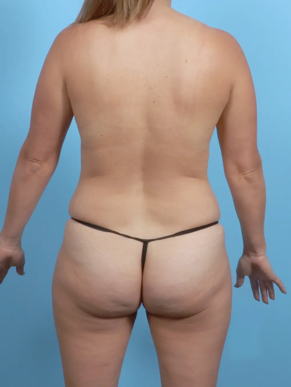 Tummy Tuck Patient Photo - Case 53888 - before view-3