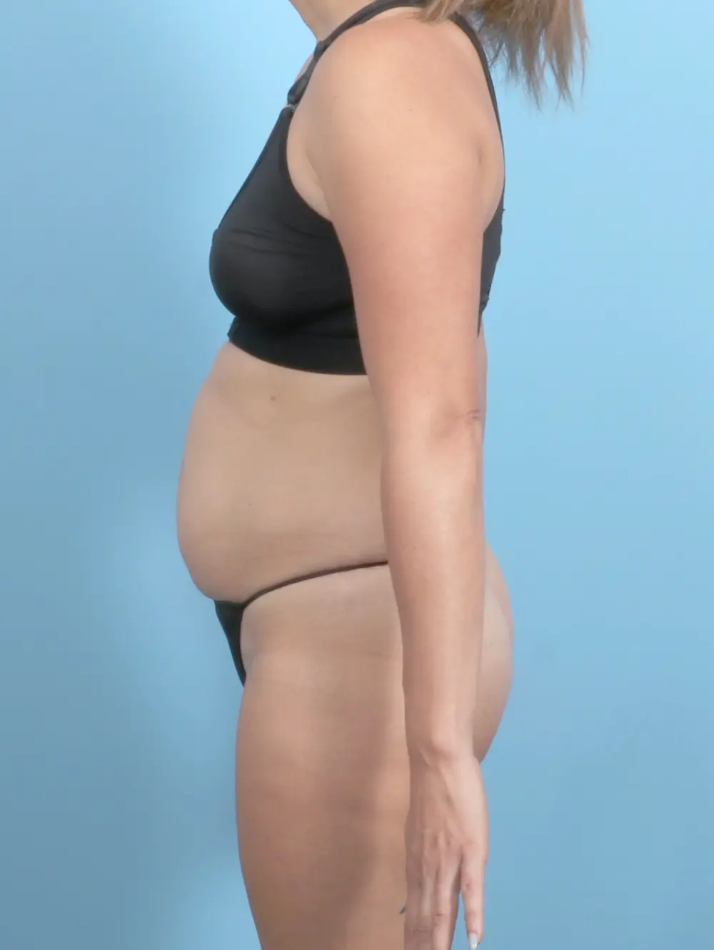 Tummy Tuck Patient Photo - Case 53888 - before view-2