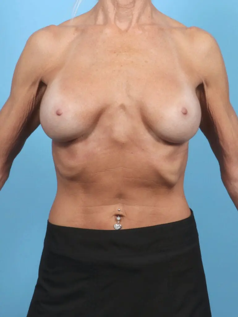 Breast Implant Revision - Case 53914 - Before