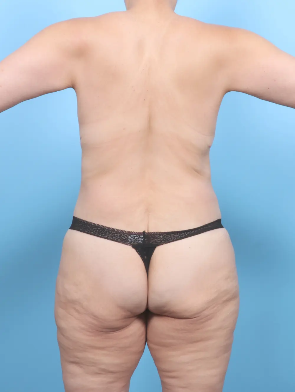 After Weight Loss Patient Photo - Case 53933 - after view-3