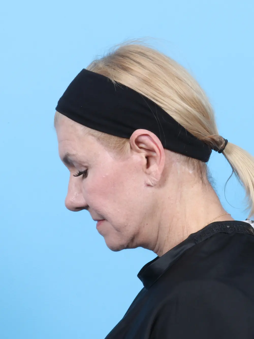 Eyelid Surgery Patient Photo - Case 54002 - after view-3