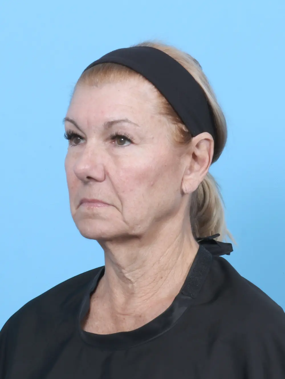 Eyelid Surgery Patient Photo - Case 54002 - before view-1