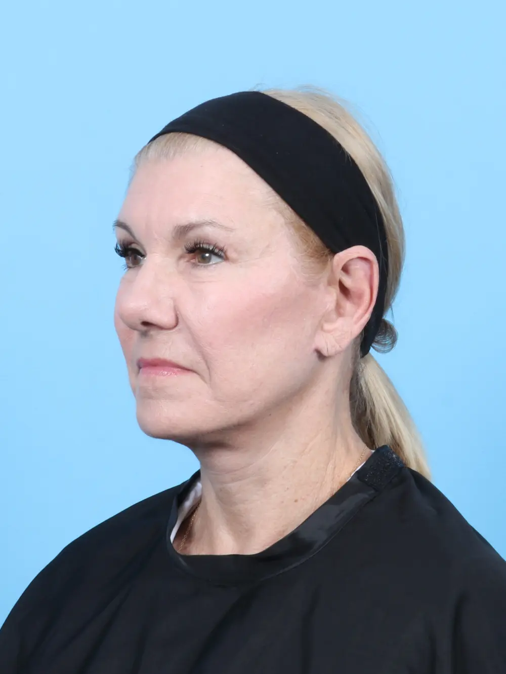 Eyelid Surgery Patient Photo - Case 54002 - after view-1
