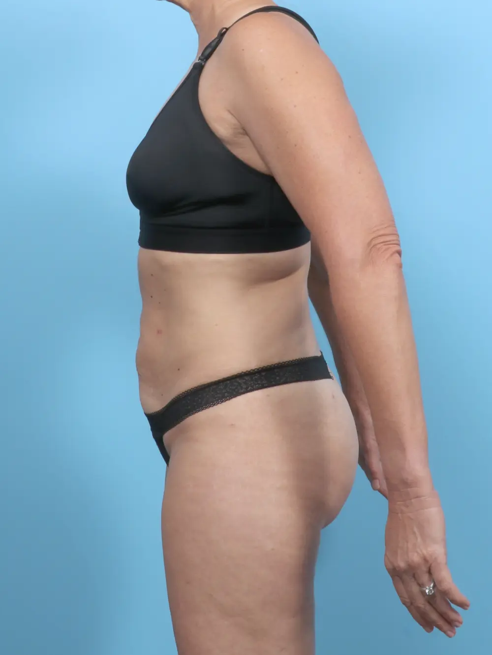 Tummy Tuck Patient Photo - Case 54022 - after view-2