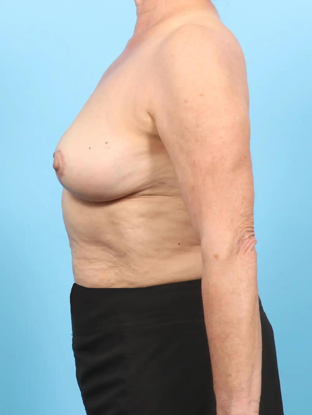 Breast Lift/Reduction w/o Implants Patient Photo - Case 54056 - after view-2