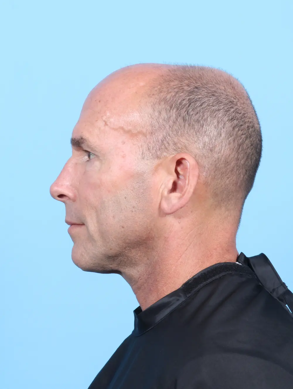 Eyelid Surgery Patient Photo - Case 54064 - after view-2