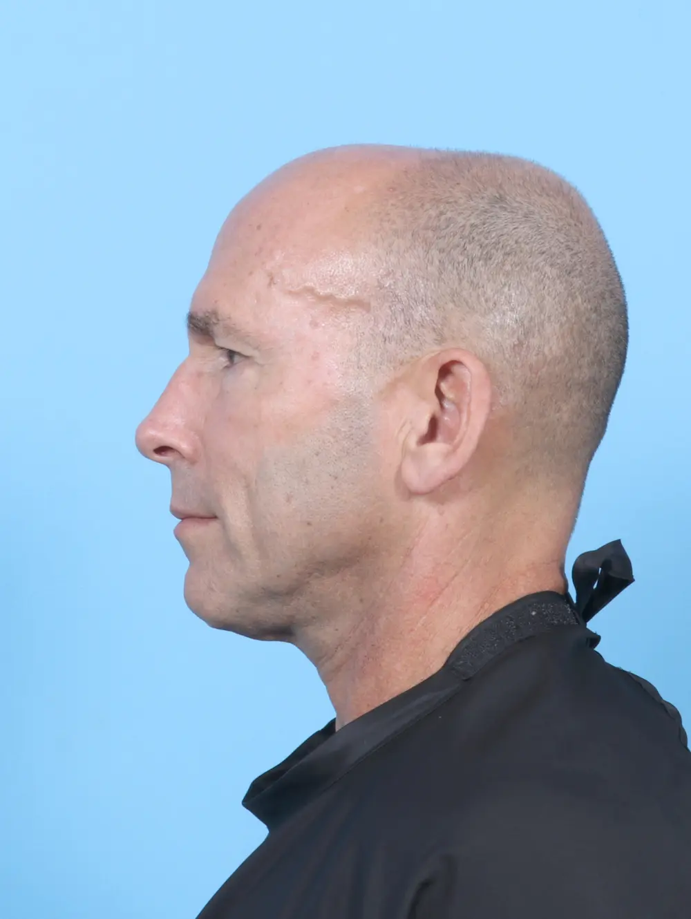 Eyelid Surgery Patient Photo - Case 54064 - before view-2