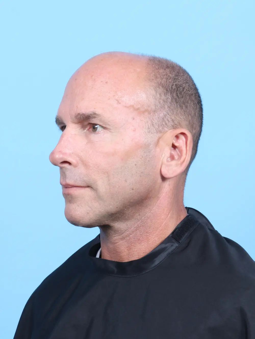 Eyelid Surgery Patient Photo - Case 54064 - after view-1