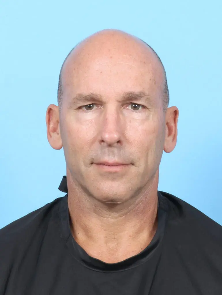 Eyelid Surgery - Case 54064 - Before