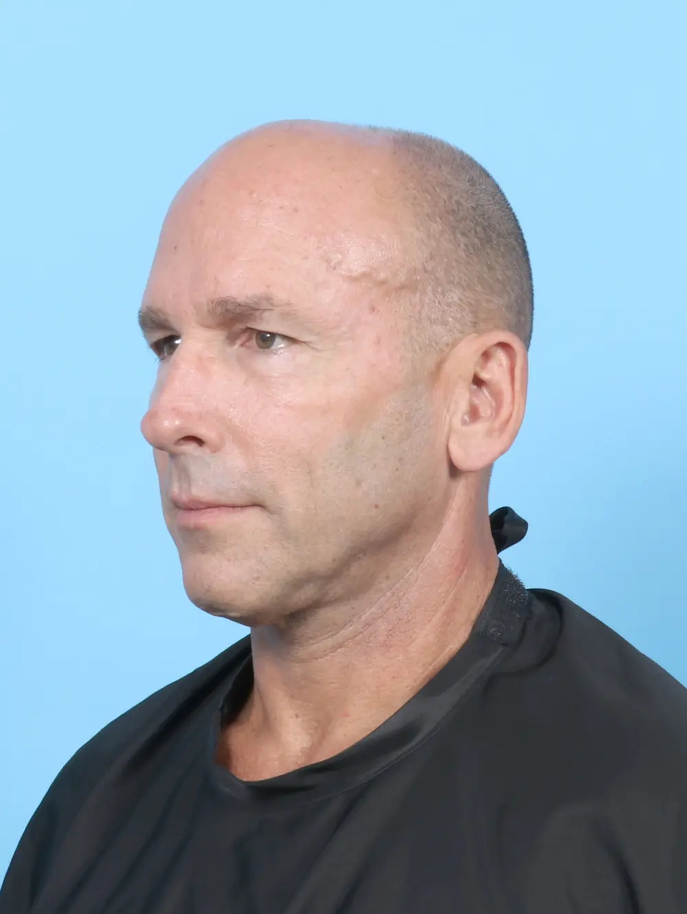 Eyelid Surgery Patient Photo - Case 54064 - before view-1