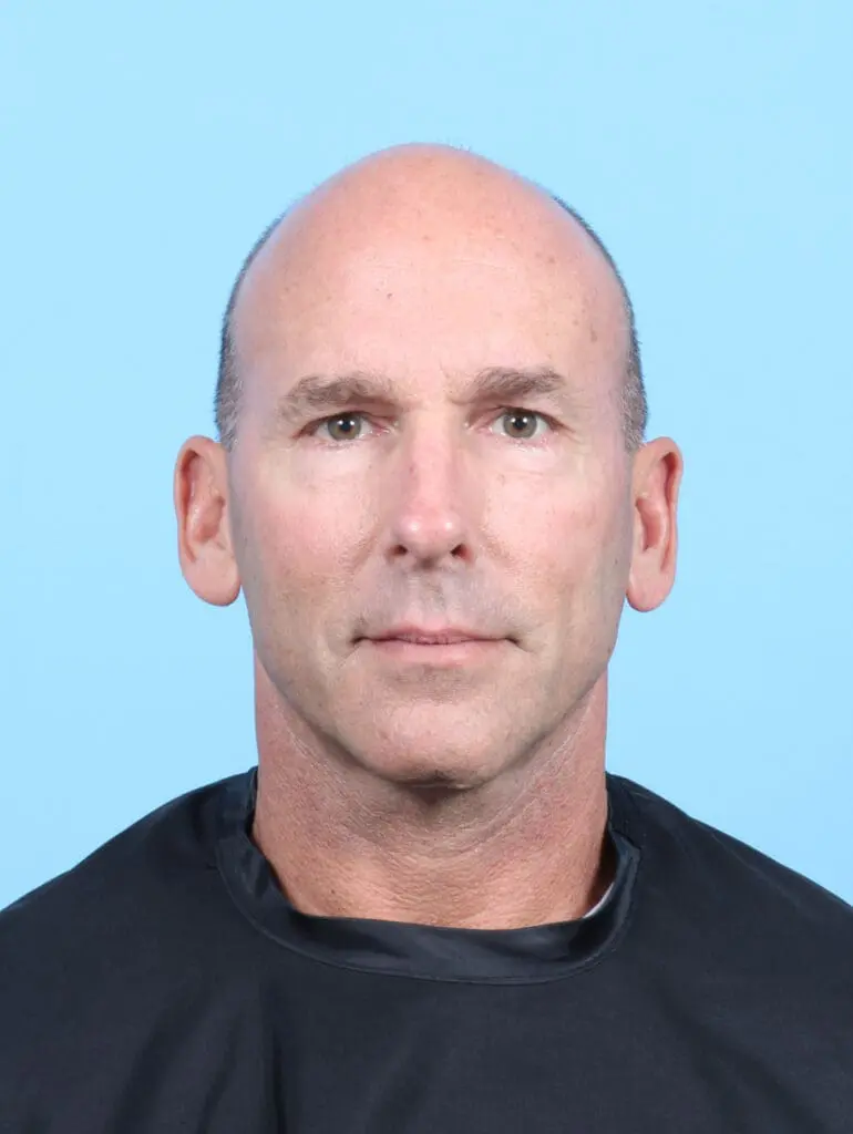 Eyelid Surgery - Case 54064 - After