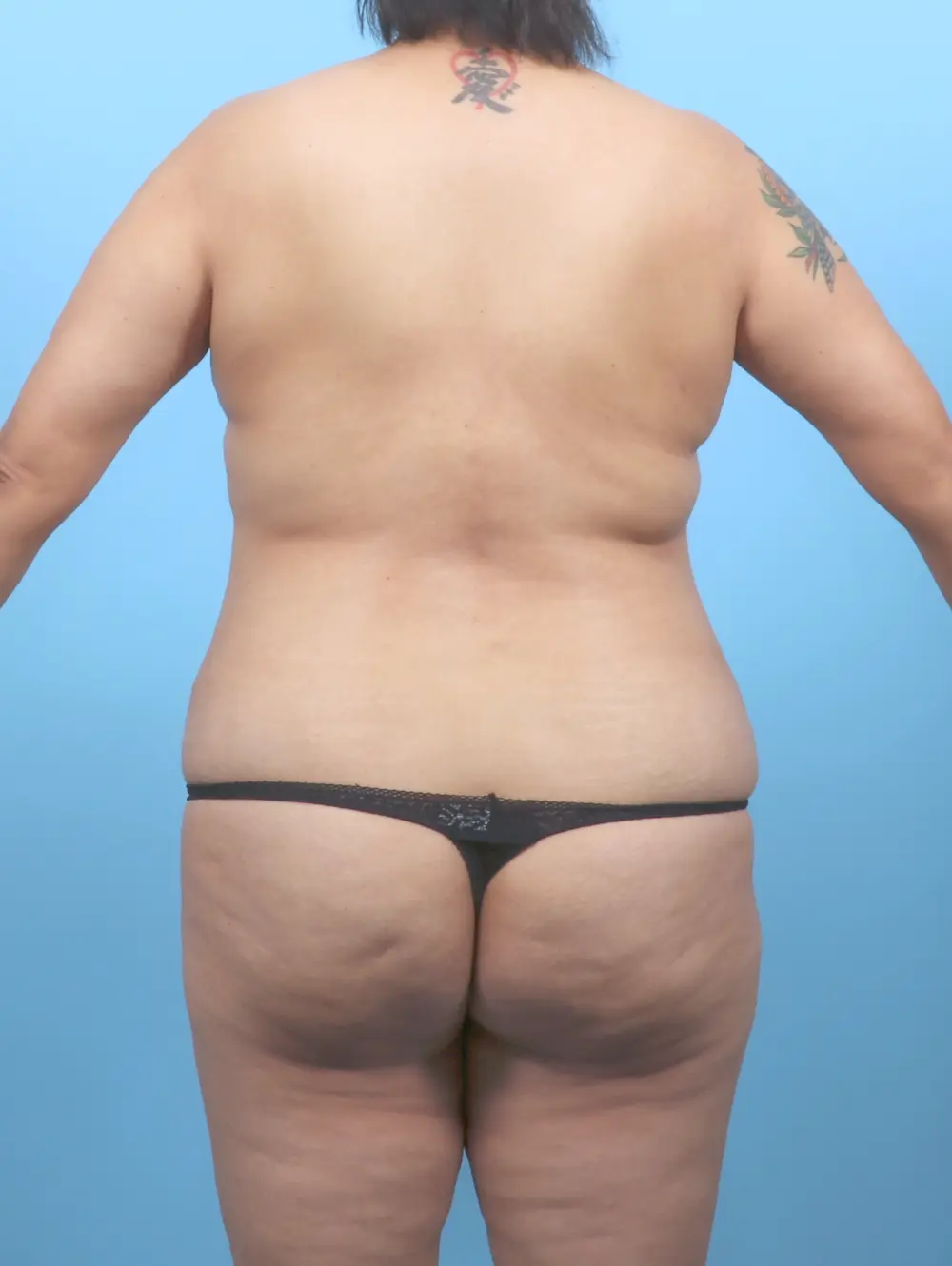 Breast Lift/Reduction w/o Implants Patient Photo - Case 54080 - before view-3