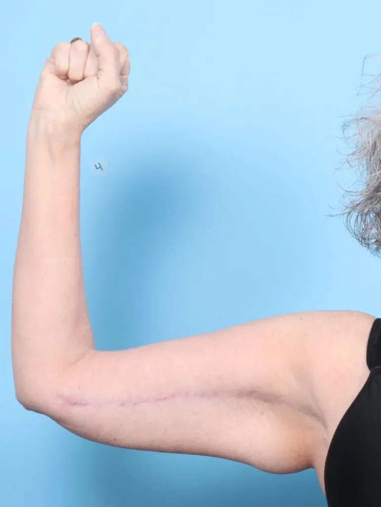 After Weight Loss - Case 54098 - After