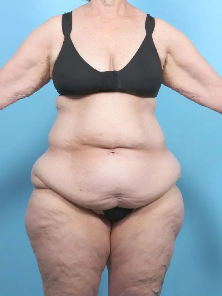 After Weight Loss - Case 54104 - Before