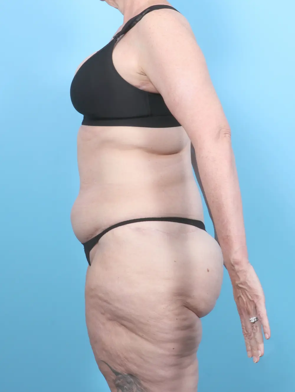 After Weight Loss Patient Photo - Case 54104 - after view-2