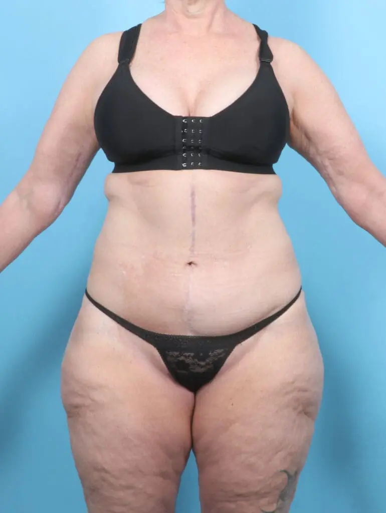 After Weight Loss - Case 54104 - After