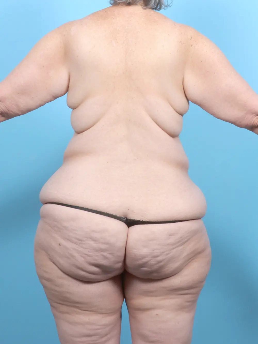 After Weight Loss Patient Photo - Case 54104 - before view-3