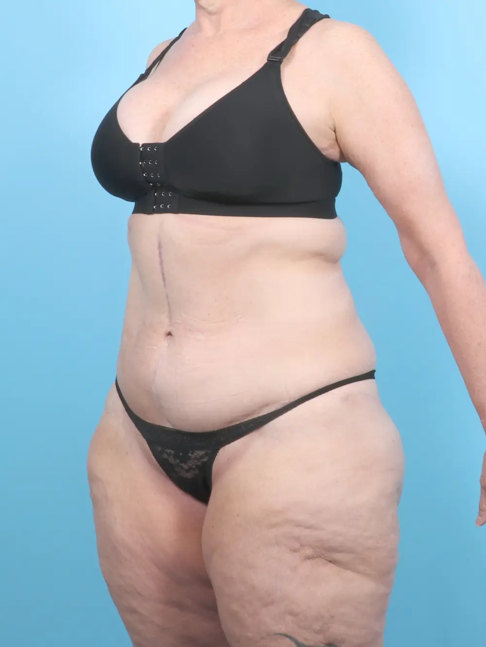 After Weight Loss Patient Photo - Case 54104 - after view-1