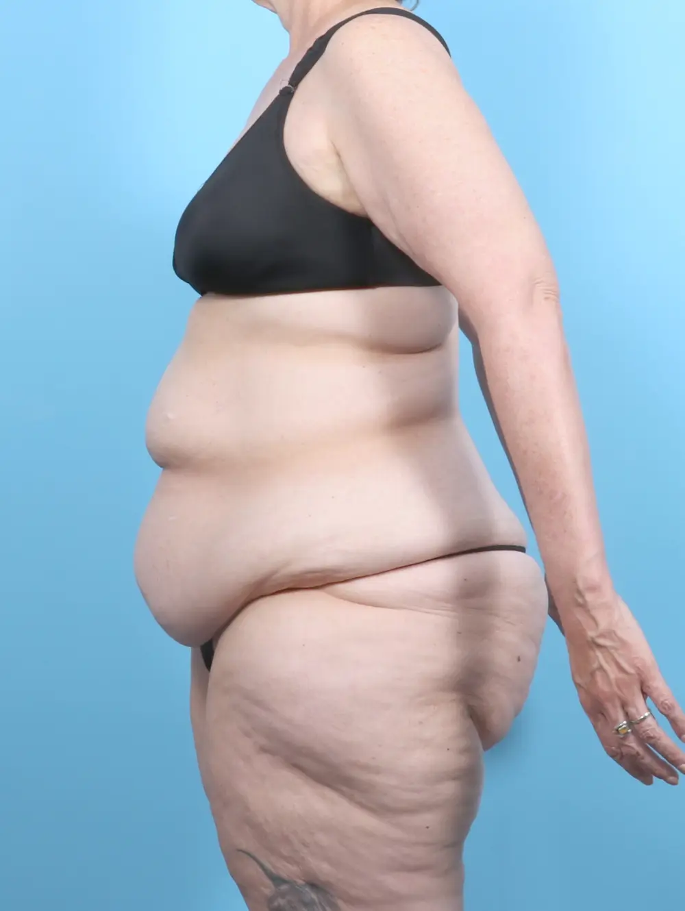 After Weight Loss Patient Photo - Case 54104 - before view-2