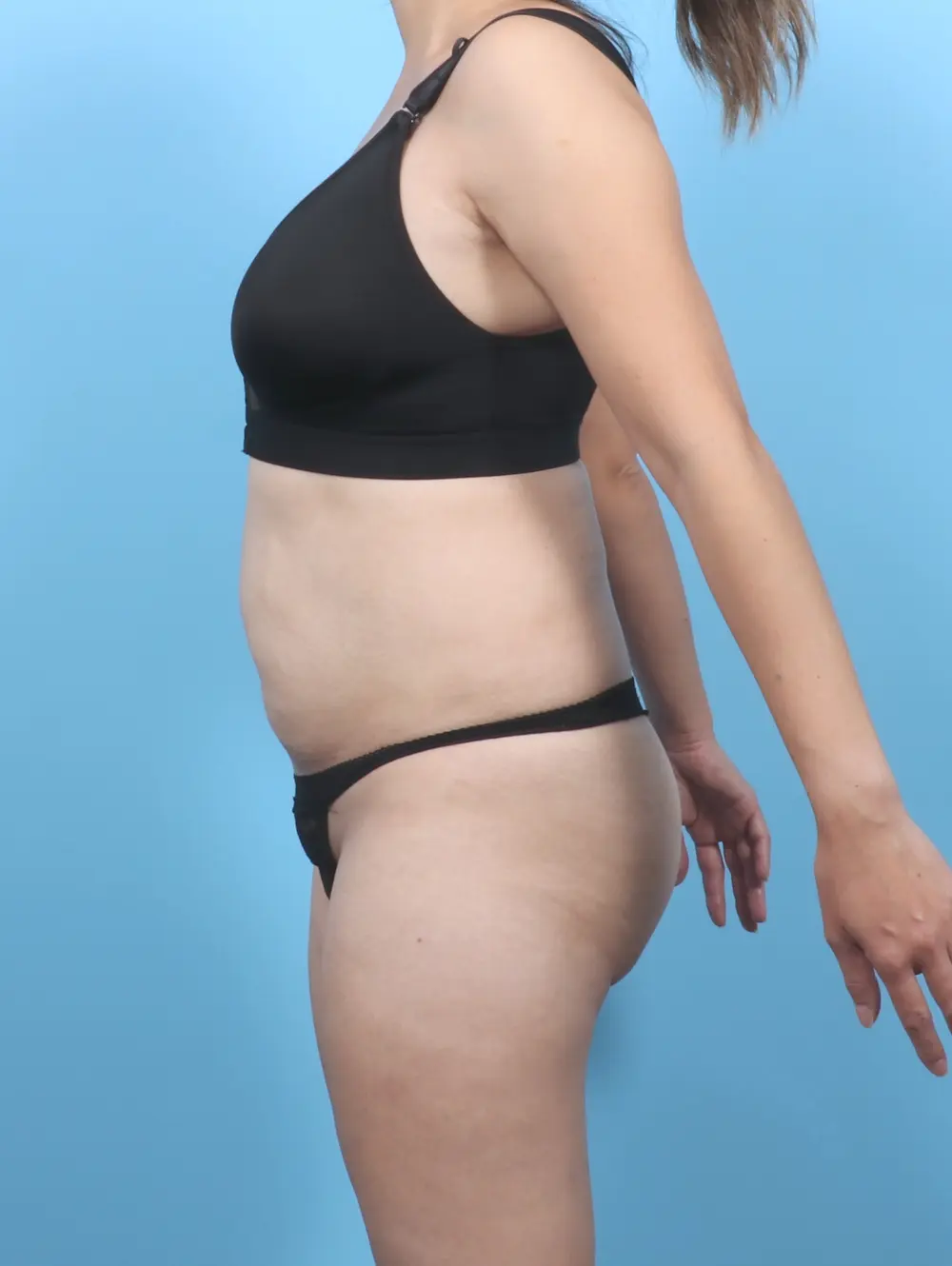 Tummy Tuck Patient Photo - Case 54139 - before view-2