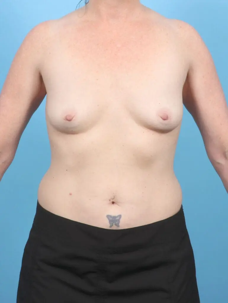 Breast Augmentation - Case 54147 - Before