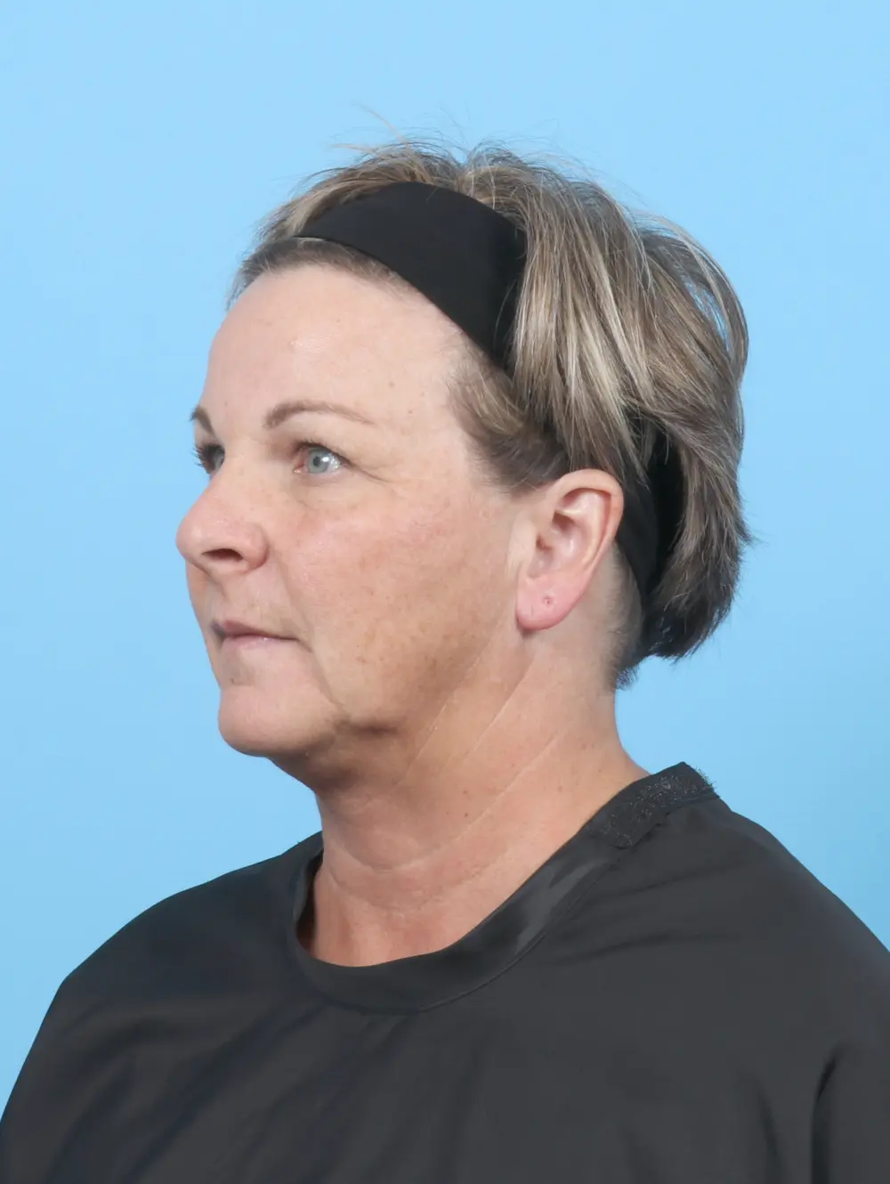 Brow Lift Patient Photo - Case 54164 - before view-1