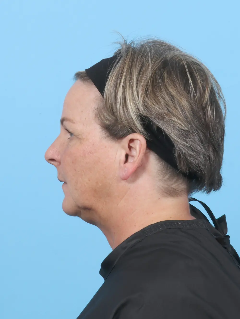 Brow Lift Patient Photo - Case 54164 - before view-2