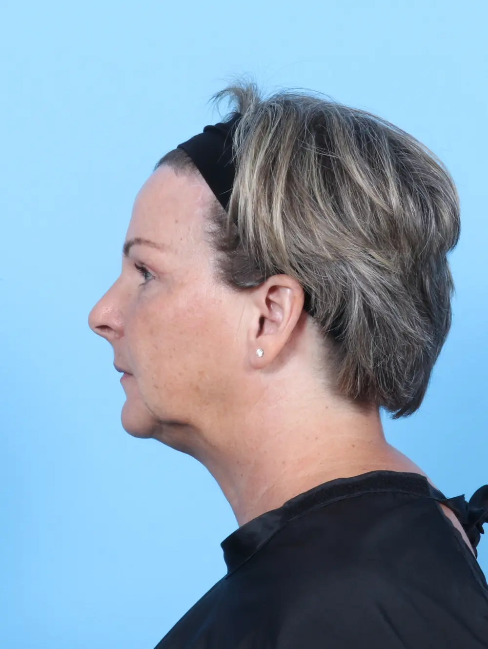 Brow Lift Patient Photo - Case 54164 - after view-2