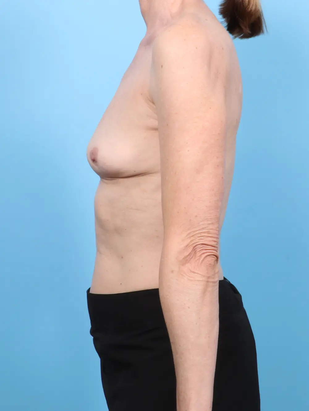 Breast Implant Removal Patient Photo - Case 54202 - after view-2