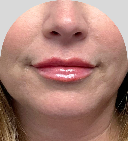 Lip Fillers - Case 54225 - After