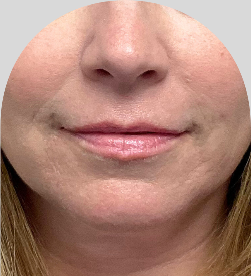 Lip Fillers - Case 54225 - Before