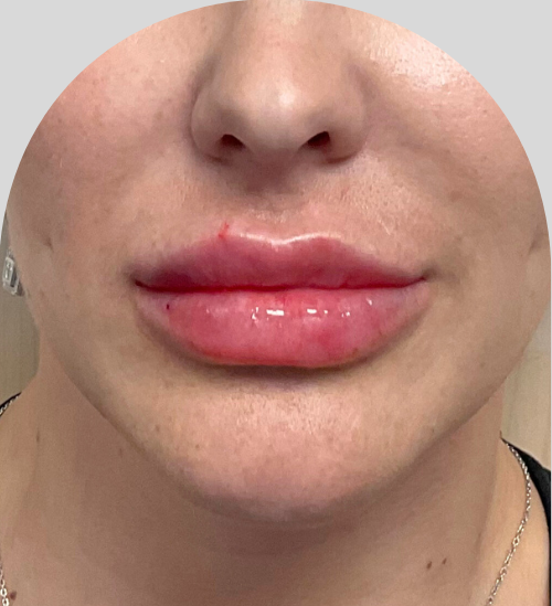 Lip Fillers - Case 54229 - After