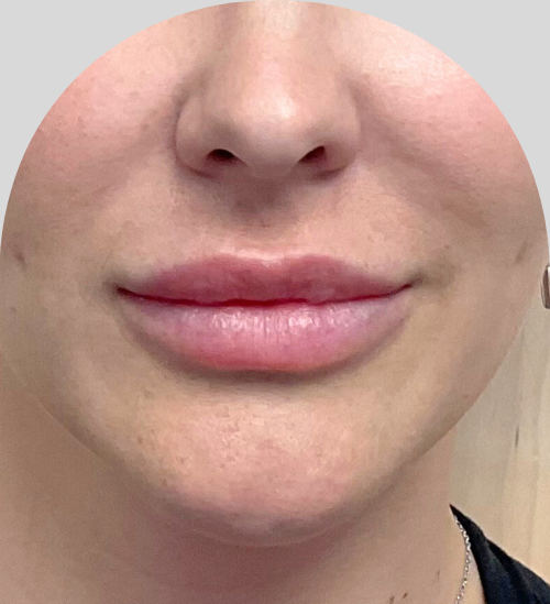 Lip Fillers - Case 54229 - Before