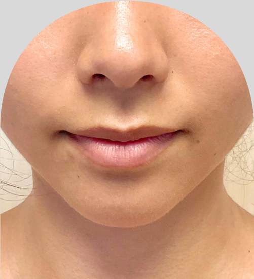 Lip Fillers - Case 54233 - Before