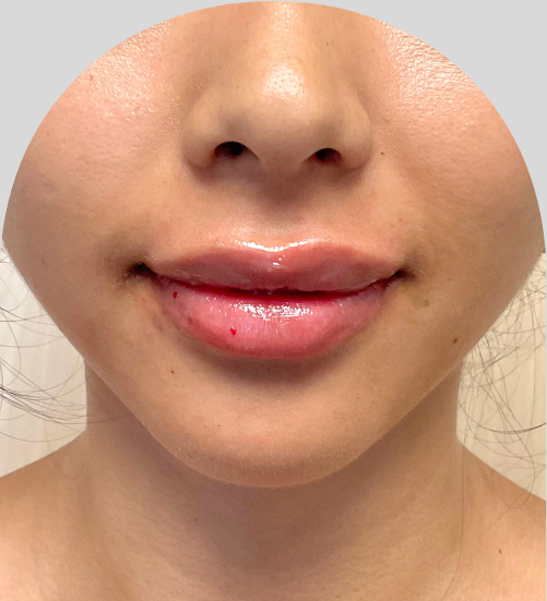 Lip Fillers - Case 54233 - After